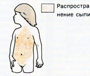 Распространение сыпи при ветряной оспе