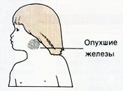 Эпидемический паротит, или свинка 