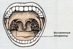 Миндалины