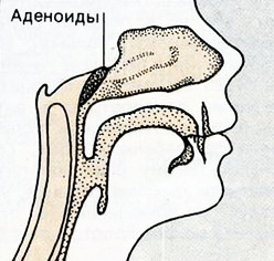 Удаление аденоидов