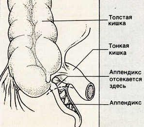 Аппендикс отсекается у основания и удаляется