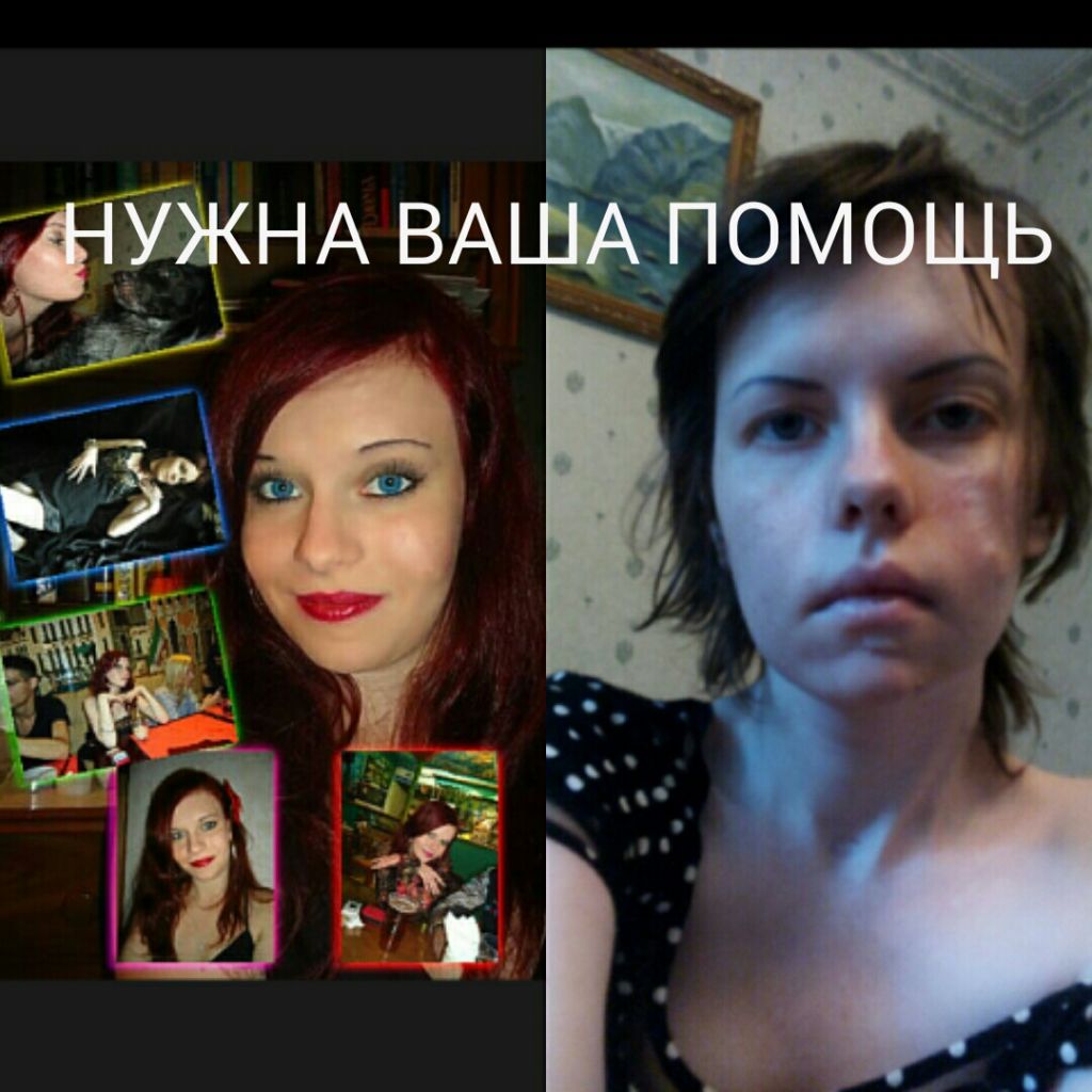 Фото для Нейрофиброматоз не приговор