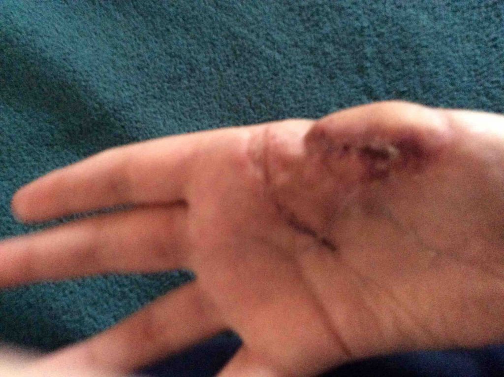 Фото для Оторвало палец, нужна поддержка