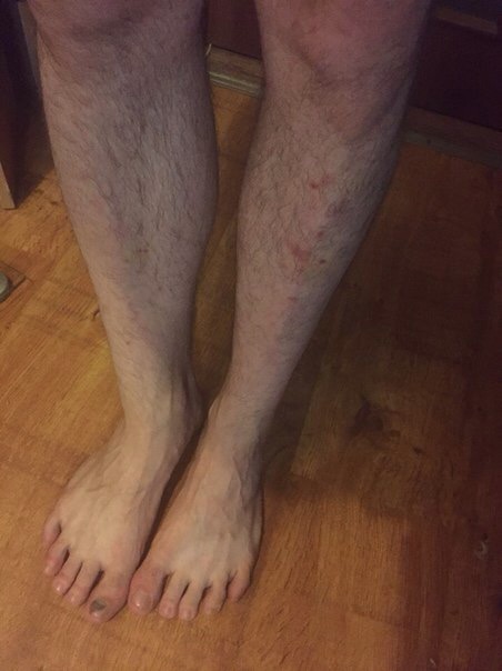 Фото для Живу с последствиями дцп. помогите на лечение
