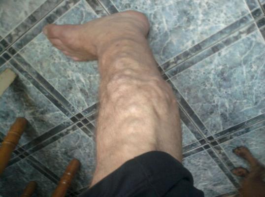 Фото для я инвалид ворикозное расширение вен нужна операция