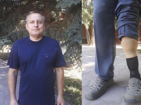 Фото для Нуждаюсь в протезе, который позволит мне ходить и найти работу