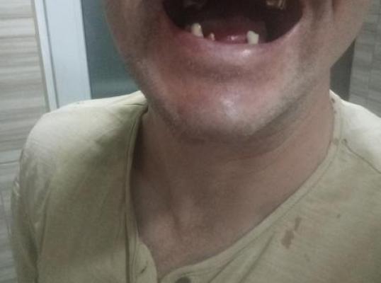 Фото для Помогите вставить зубы. 